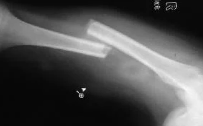 Elderly Woman Endures 3 Days With Broken Femur, With Only Muscle Rub For Pain!